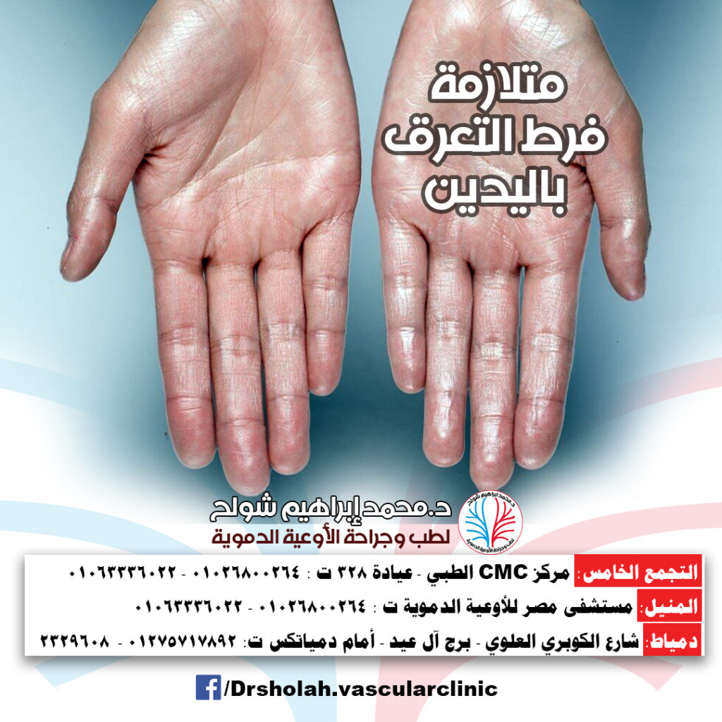 متلازمة فرط التعرق باليدين Hand Hyperhidrosis Syndrome: Causes