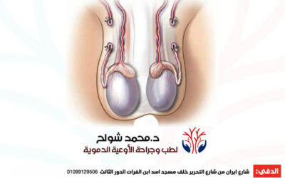 علاج دوالي الخصية عند الرجال