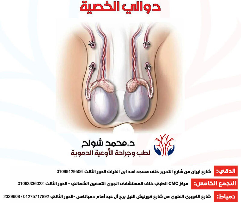 علاج دوالي الخصية عند الرجال