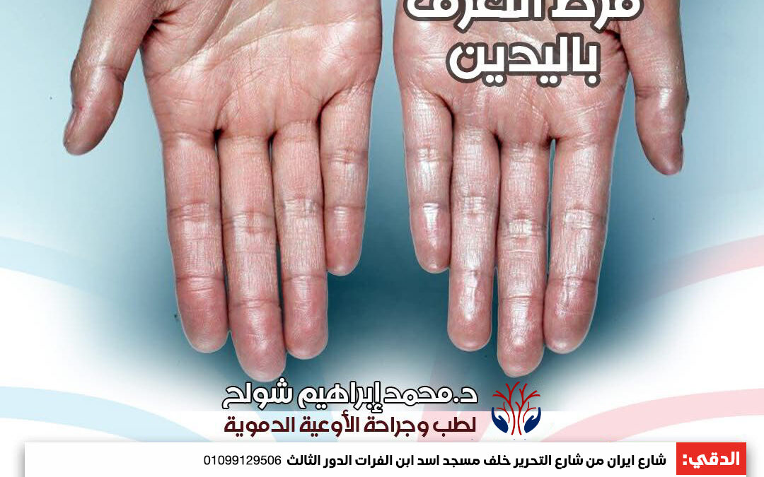 متلازمة فرط التعرق باليدين: الأسباب، الأعراض، وطرق العلاج الفعّالة