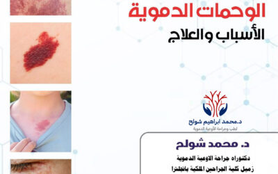 علاج الوحمة الدموية