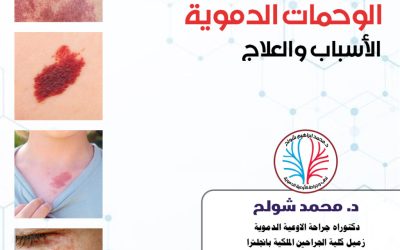 الوحمات الدموية