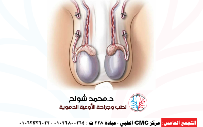دوالي الخصية: الأسباب، الأعراض، وأفضل طرق العلاج بالجراحة الدقيقة