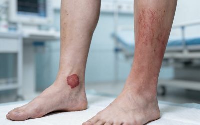 علاج التهابات الشرايين المناعية