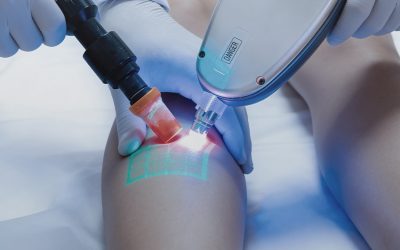 علاج الدوالى بتقنية الكلاكس