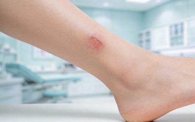 علاج القرح الوريدية