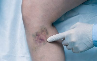 علاج جلطات أوردة الساق