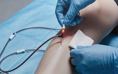 علاج دوالي الساقين بالليزر