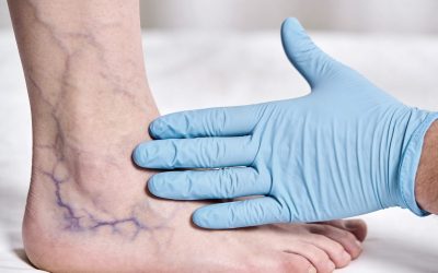 علاج دوالي الساقين بدون جراحة