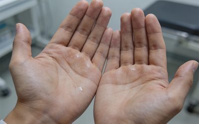 علاج متلازمة فرط التعرق باليدين