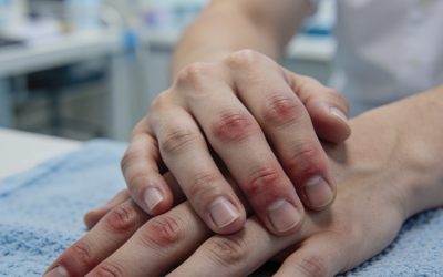 علاج مرض رينودز