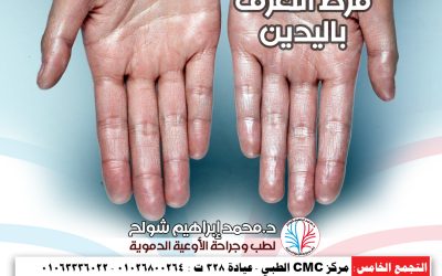 متلازمة فرط التعرق باليدين: الأسباب، الأعراض، وطرق العلاج الفعّالة